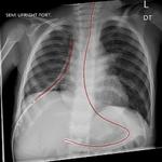 Deep learning methods for segmentation of lines in pediatric chest radiographs